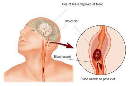 โรคหลอดเลือดสมองตีบตัน Stroke